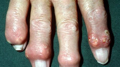 Gout Symptoms: Managing, Risk Factors, and Complications