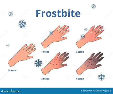 Frostbite Stages, Vector Cartoon Illustration of Hands Stock Vector - Illustration of care, flat ...