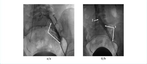 Pelvic Phlebography Patient M 27 Years Old A Obstruction Of The