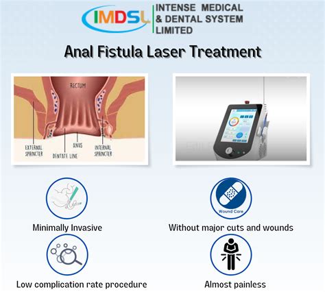 Laser For Fistula