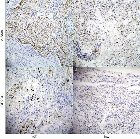 Immunohistochemical staining of α smooth muscle actin SMA and CD204