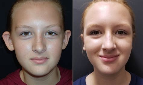 Protruding Ears Gallery Richmond VA | Cosmetic Facial Surgery