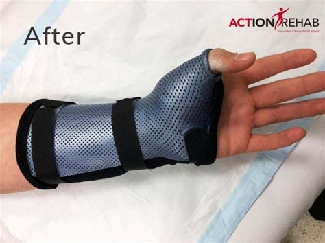 Scaphoid Fracture Treatment Melbourne Gippsland