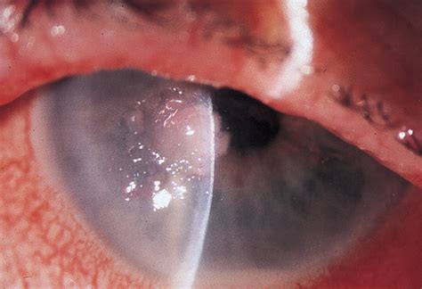 Oculoglandular Tularemia Infectious Diseases Jama Ophthalmology