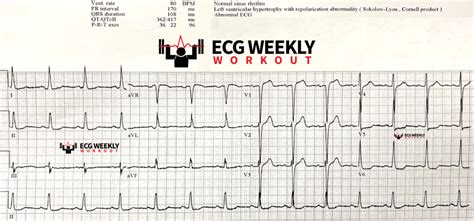 Stat Ecg Diagnoses How To Identify Acute Coronary Occlusion Mi In