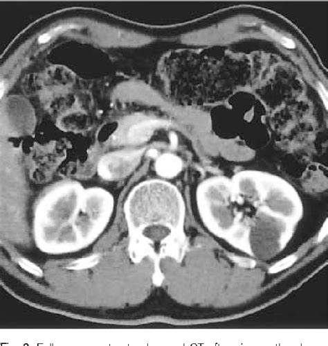 Figure 2 From Solitary Extramedullary Plasmacytoma Of The Liver Without