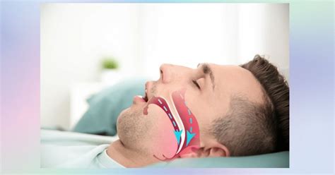 Effective Maskless Sleep Apnea Treatment Options Drmtm U