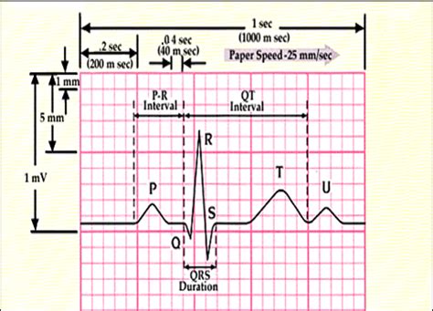 Ecg Paper Nursing Mnemonics Nursing School Notes Ekg Interpretation Cheat Sheets