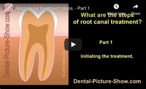 Root canal procedure step by step