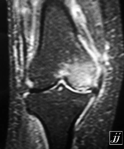 Msk Bone Bruising Of Femoral Condyle And Joint Effusion And
