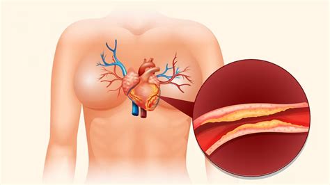 World Heart Day Expert Explains About Angioplasty And Stent