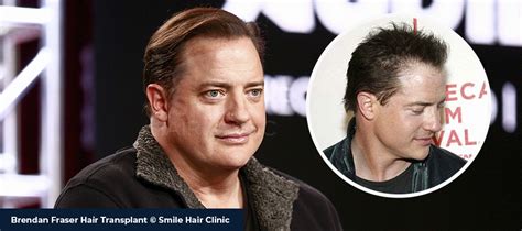 El Trasplante De Cabello De Brendan Fraser Trasplante Capilar L