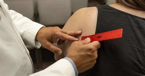 how to know if you have melanoma skin cancer