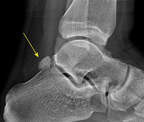 OS Trigonum Fracture