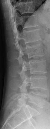 Lateral Lumbar Spine X Ray Anatomy