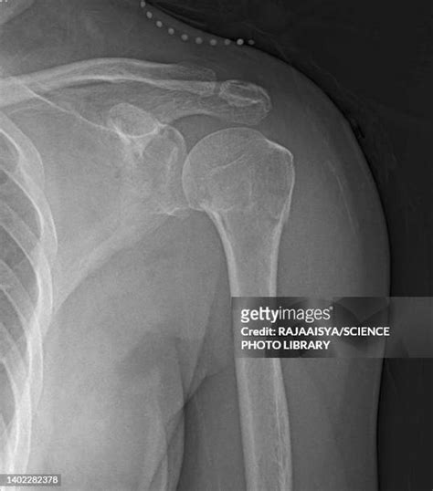 15 Proximal Humerus Fracture Stock Photos, High-Res Pictures, and ...