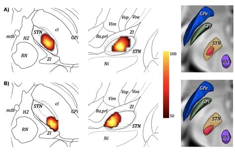 Focused Ultrasound Subthalamotomy In Parkinson S Disease Lesion