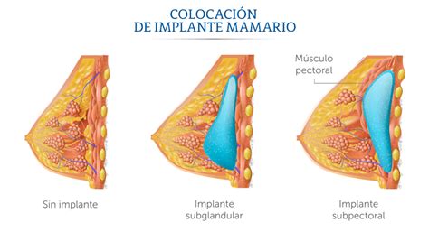 Médica Sur Cirugía de senos mamoplastia