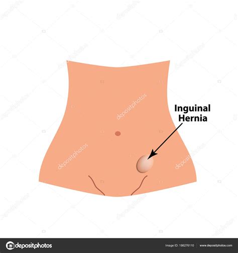 Inguinal Hernia Intestinal Hernia Infographics Vector The Best Porn