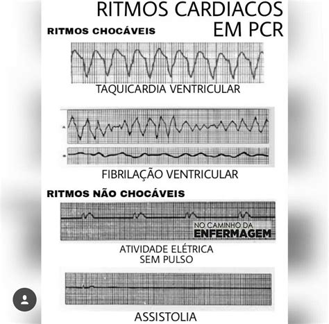 Ritmos Chocáveis E Não Chocáveis Pdf - Ritmos Cardíacos Chocáveis E Não Chocáveis - BRAINCP