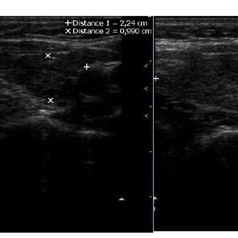 TUS of atrophic thyroiditis (a patient with mild hypothyroidism: TSH ...