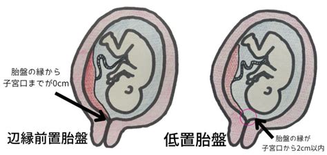 前置胎盤や低置胎盤と診断されたら？妊娠中の注意点や出産準備・出産方法について解説！ あなただけの Only One 助産師