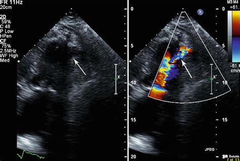 Complications of TAVR | Radiology Key