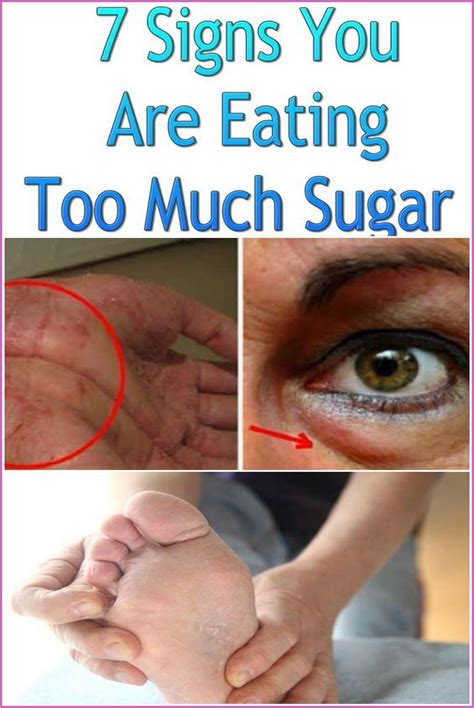 7 Signs You Are Eating Too Much Sugar Medicina Natural Salud Y