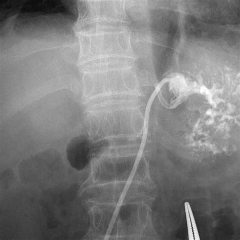 Percutaneous Transhepatic Drainage Of The Liver Abscess 7 French