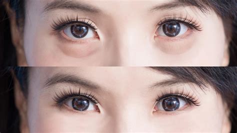 Paano Matanggal Ang Eye Bags Pepph