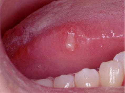 White Mouth Sores On Tongue