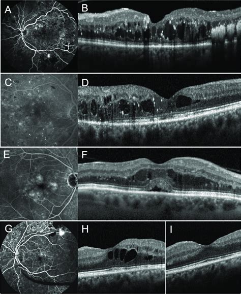 Multimodal Clinical Imaging Of Diabetic Macular Edema A B Optical Download Scientific Diagram