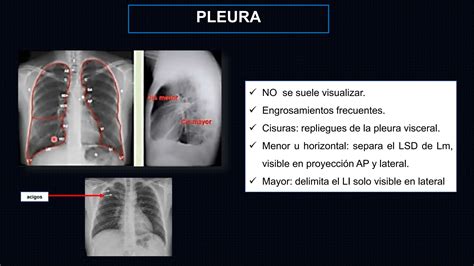 Taller De Radiografia De Tórax Normalpptx Ppt