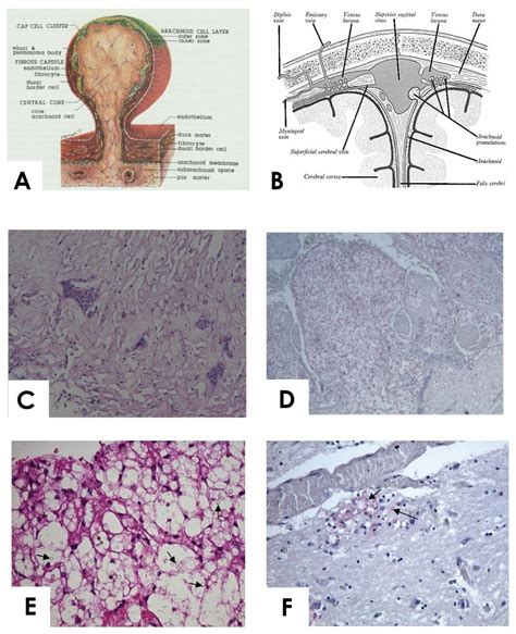 Arachnoid Granulations Histology