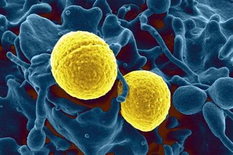 Zdradziecki Staphylococcus: Objawy i manifestacje