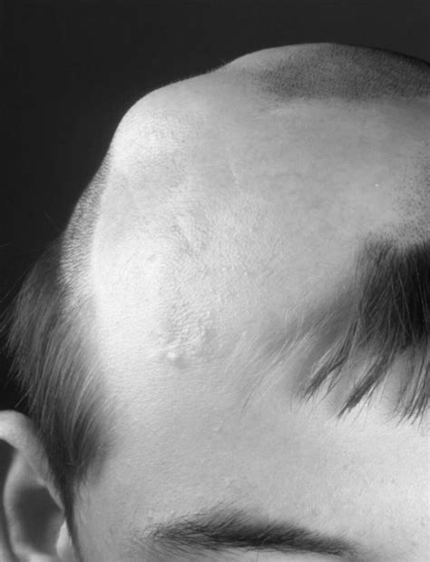 Encephalocraniocutaneous lipomatosis | Journal of Medical Genetics