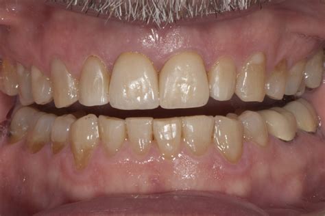 Before And After Gallery Envision Dental Dentist In Marietta Ga