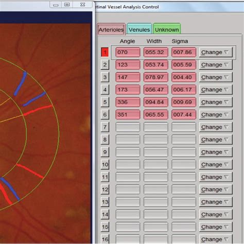 Digitized Retinal Photograph Zone A Is A Half Disc Diameter From The