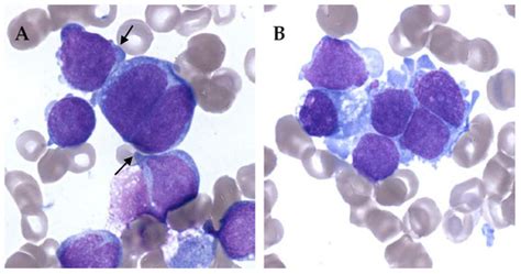 Cancers Free Full Text Infant Acute Myeloid Leukemia A Unique