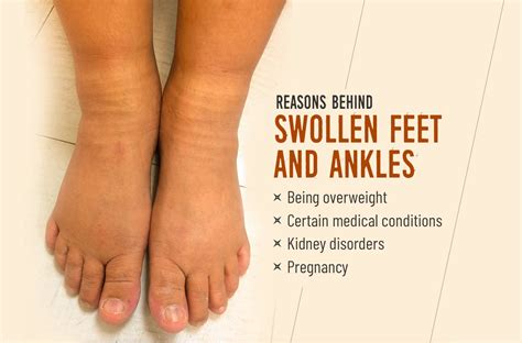 What Are The Reasons Behind Swollen Feet And Ankles