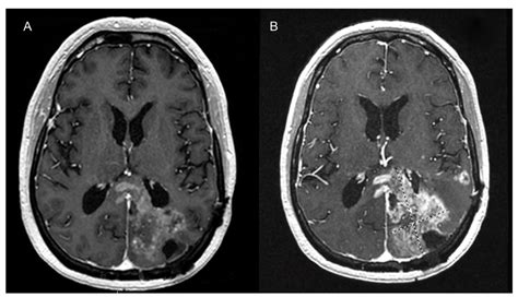 T1 Weighted Contrast Enhanced Axial Image Of The Brain With A Left