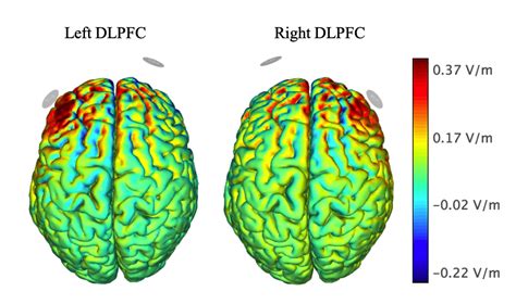 Dorsolateral Prefrontal Cortex Tdcs