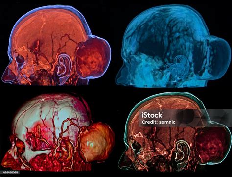 Tumor Osseo Parietal Do Cranio