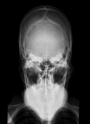 Xray Image Of Human Skull Towns View For Diagnosis Skull Fracture ...