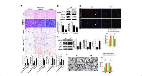 Stat Hif A Expression In Keloid Tissue And Defective Autophagy In