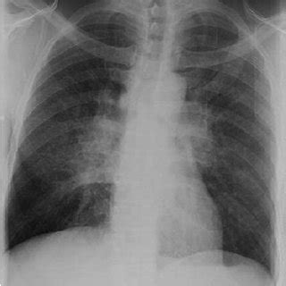 Frontal Chest Radiograph Shows Bilateral Hilar Fullness And Perihilar