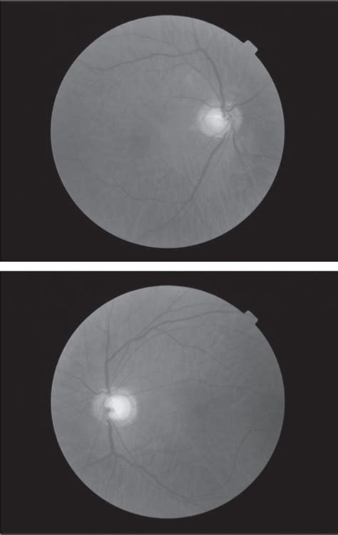 Bilateral retrograde optic neuropathy — A glaucoma masquerader