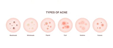 acne treatment  singapore asia wellness medical centre