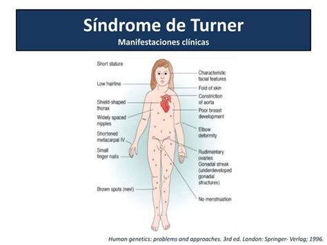 Perlas Clínicas Síndrome De Turner Ppt