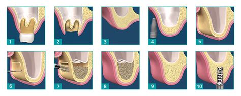 Maxillary Sinus Floor Elevation